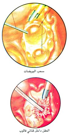 سحب البويضات / الحقن داخل قناتي فالوب